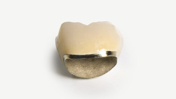 Oral Design Center Holland - metaallegeringen kroon