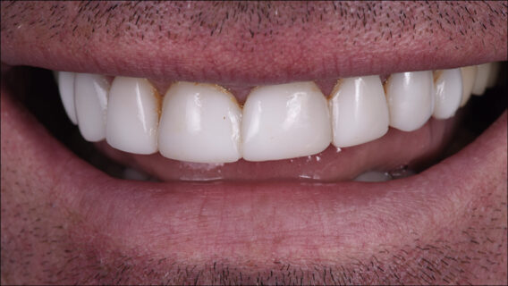 Oral Design Center Holland - ODCH_Casus_13-